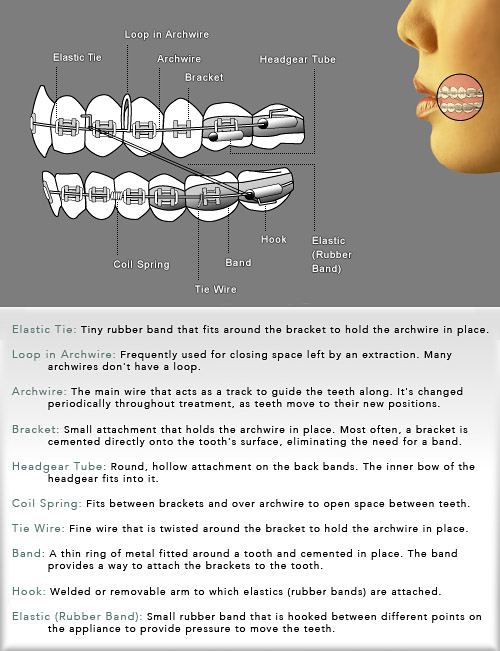 Braces Diagram  Wright Orthodontics Atlanta, Marietta, GA